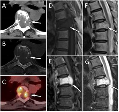 CT, MRI, and PET/CT imaging features of thoracic spine epithelioid hemangioma: a retrospective observational study